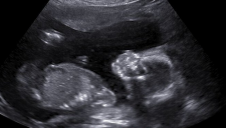 sneak peek ultrasound studio sneak peek ultrasound studio